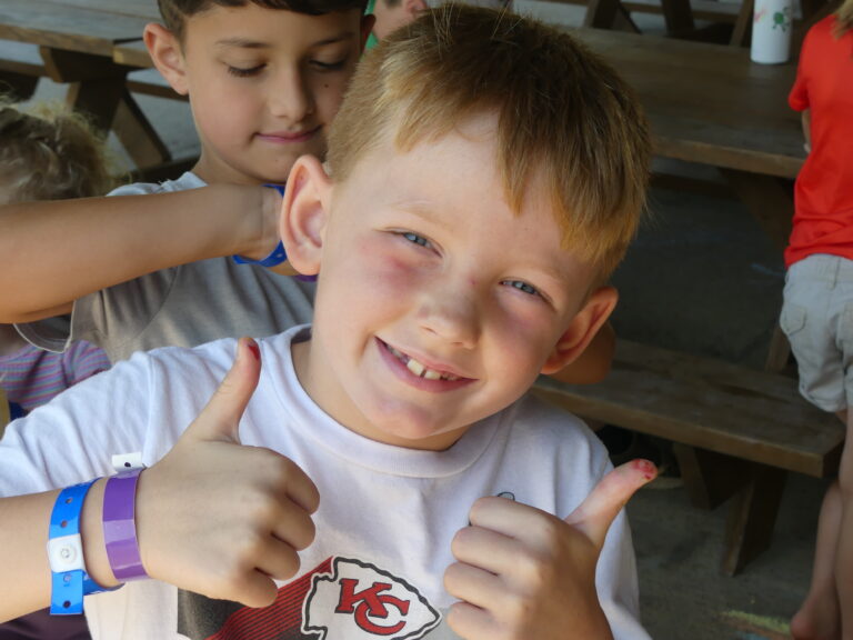 May show: Smiling boy with a bruised and swollen left eye gives two thumbs up while another child stands behind him.